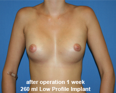 plastic-surgery-breast-augmentation